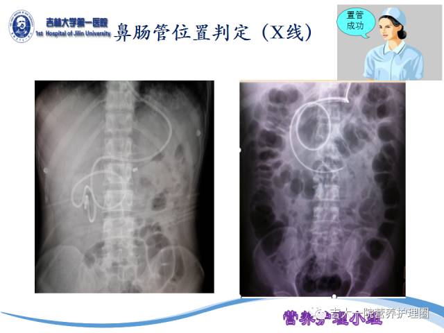 最新鼻腸管護理PPT解讀與應用探討，專業(yè)護理指南與實踐探討